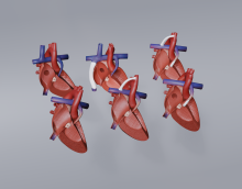 Pulmonary Atresia with Intact Ventricular Septum Models